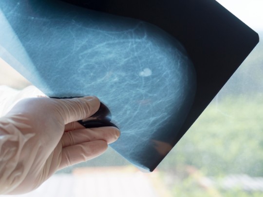 A doctor examines a tumor visible in a breast x-ray,